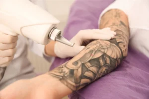 Detatouage-au-Laser